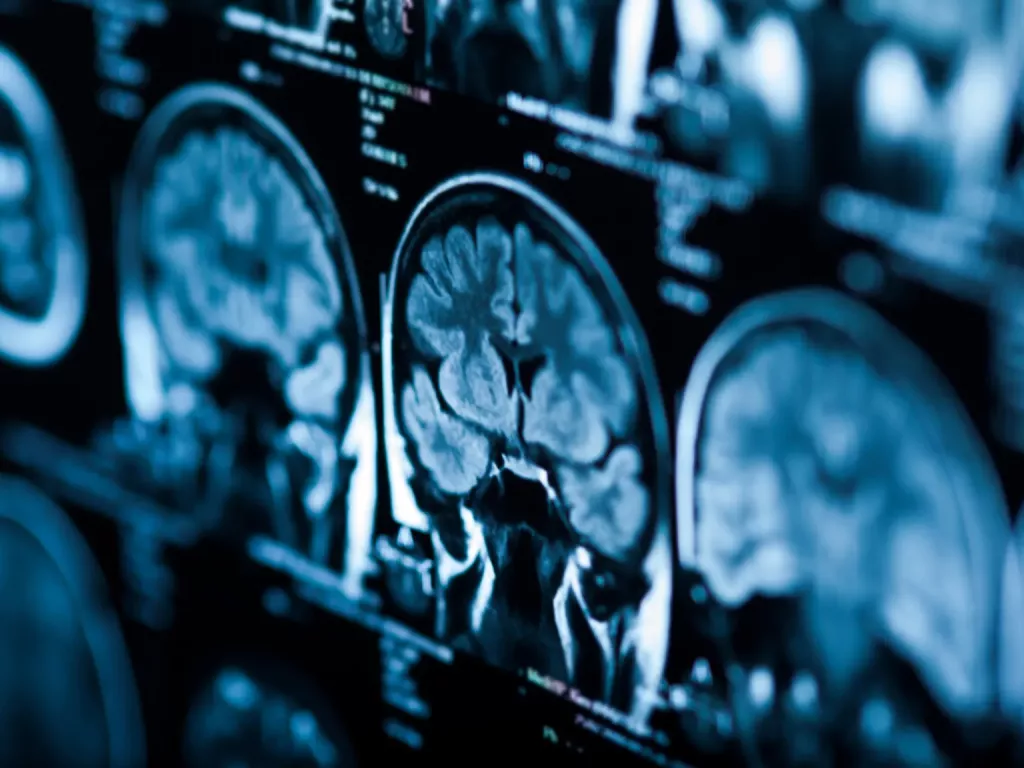 What Criteria Should Describe HIV-Related Cognitive Impairment?